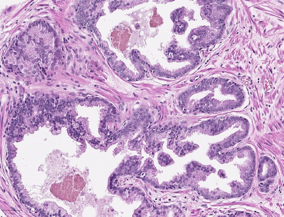 Cancerous prostate tissue histology slide
