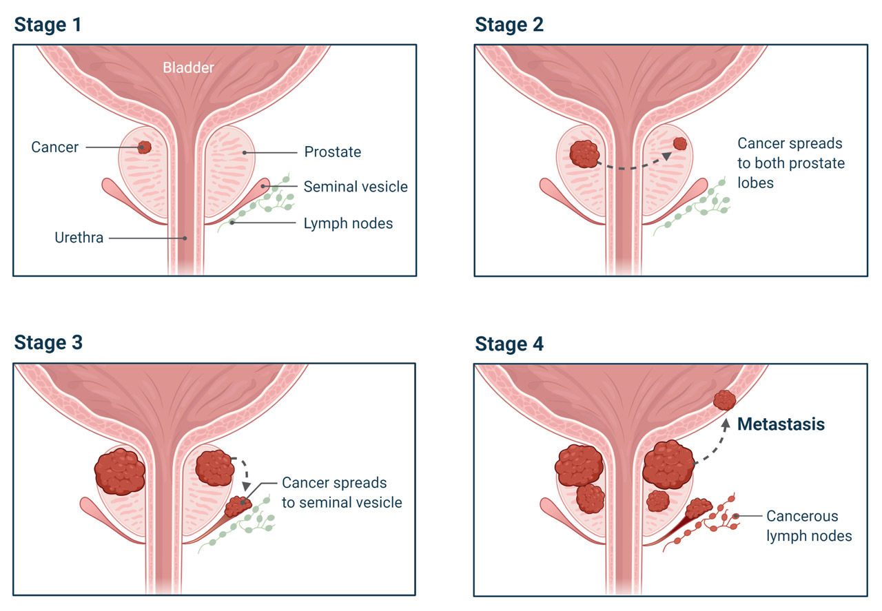 Prostate Cancer Stages Infographic