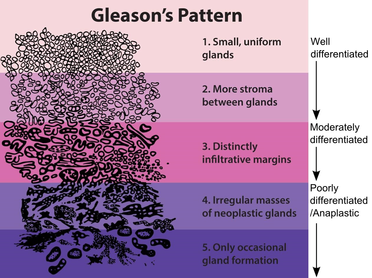 Gleasons pattern