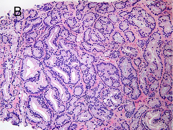 Prostate cancer with Gleason score 7 with minor component of cribriform glands