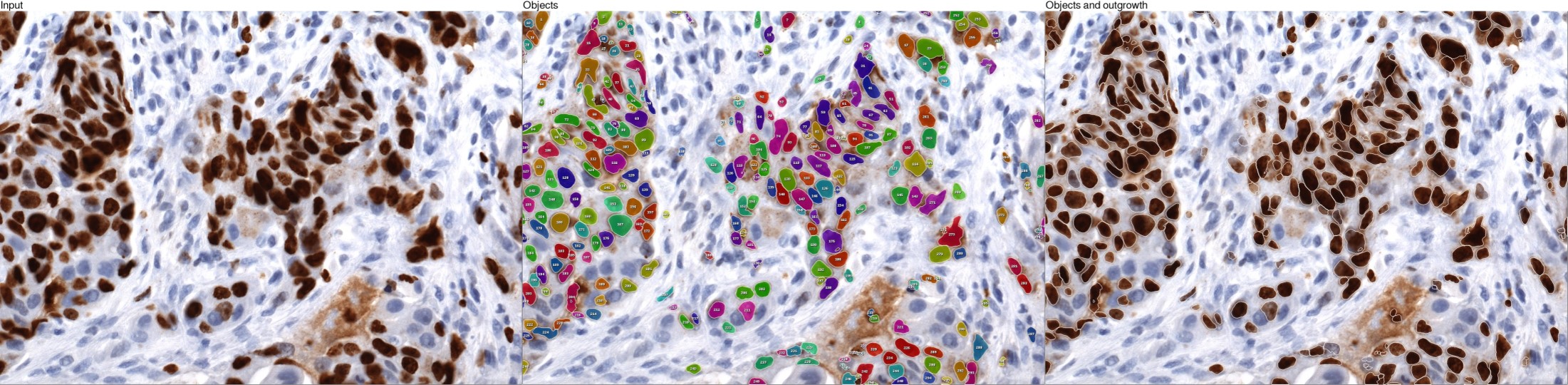 Segmentation of cell nuclei using a custom application trained with IKOSA AI on tissue images based on Ki-67 chromogenic singleplex staining