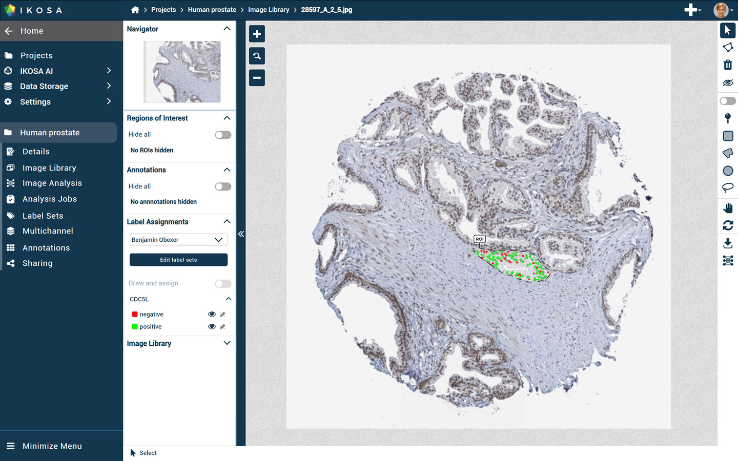 Human prostate sample slide viewed in the image analysis software IKOSA